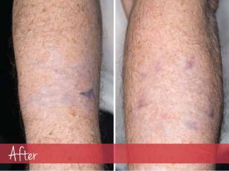 Tattoo removal - after images