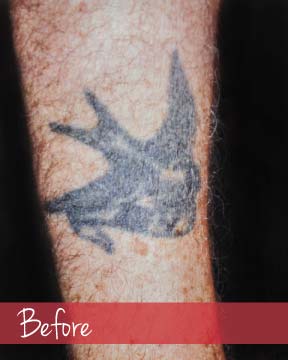 Tattoo removal - before image