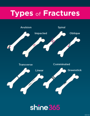 Infographic listing different types of bone fracture