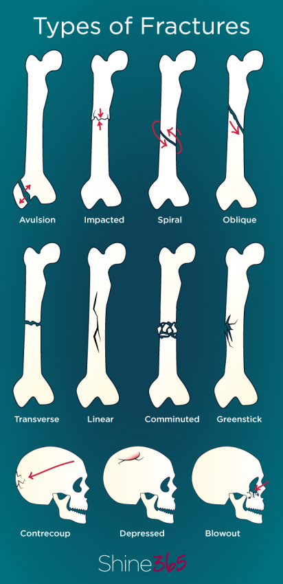 types of bone fractures informative chart