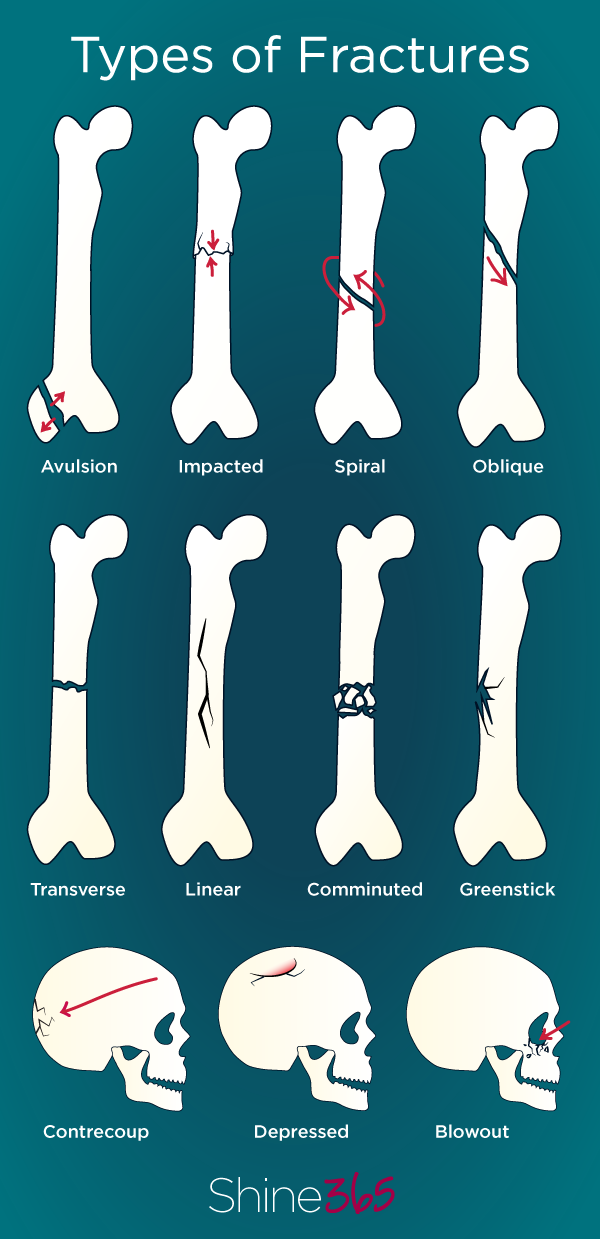 Your most common broken bone questions answered
