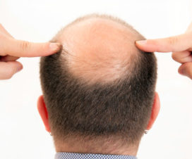 pointing to a bald spot