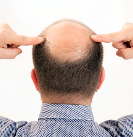 bald man pointing to his hair loss