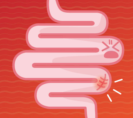 Graphic of cartoon intestine in pain - Colon polyps related to colon cancer