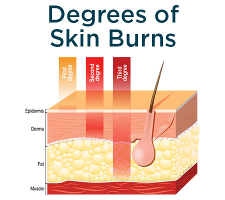 first-degree, second-degree or third-degree burn