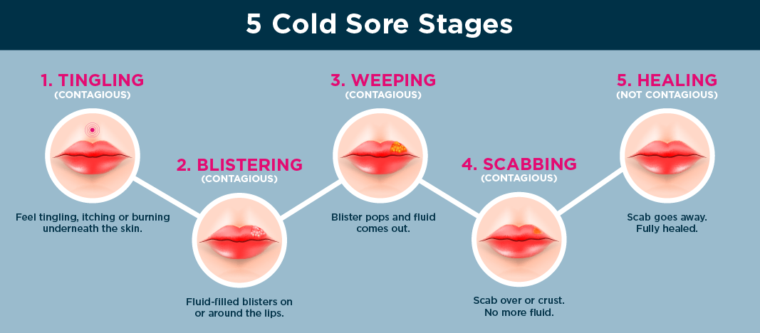 Cold Sores Are Contagious Until Fully Healed Shine365 From Marshfield 